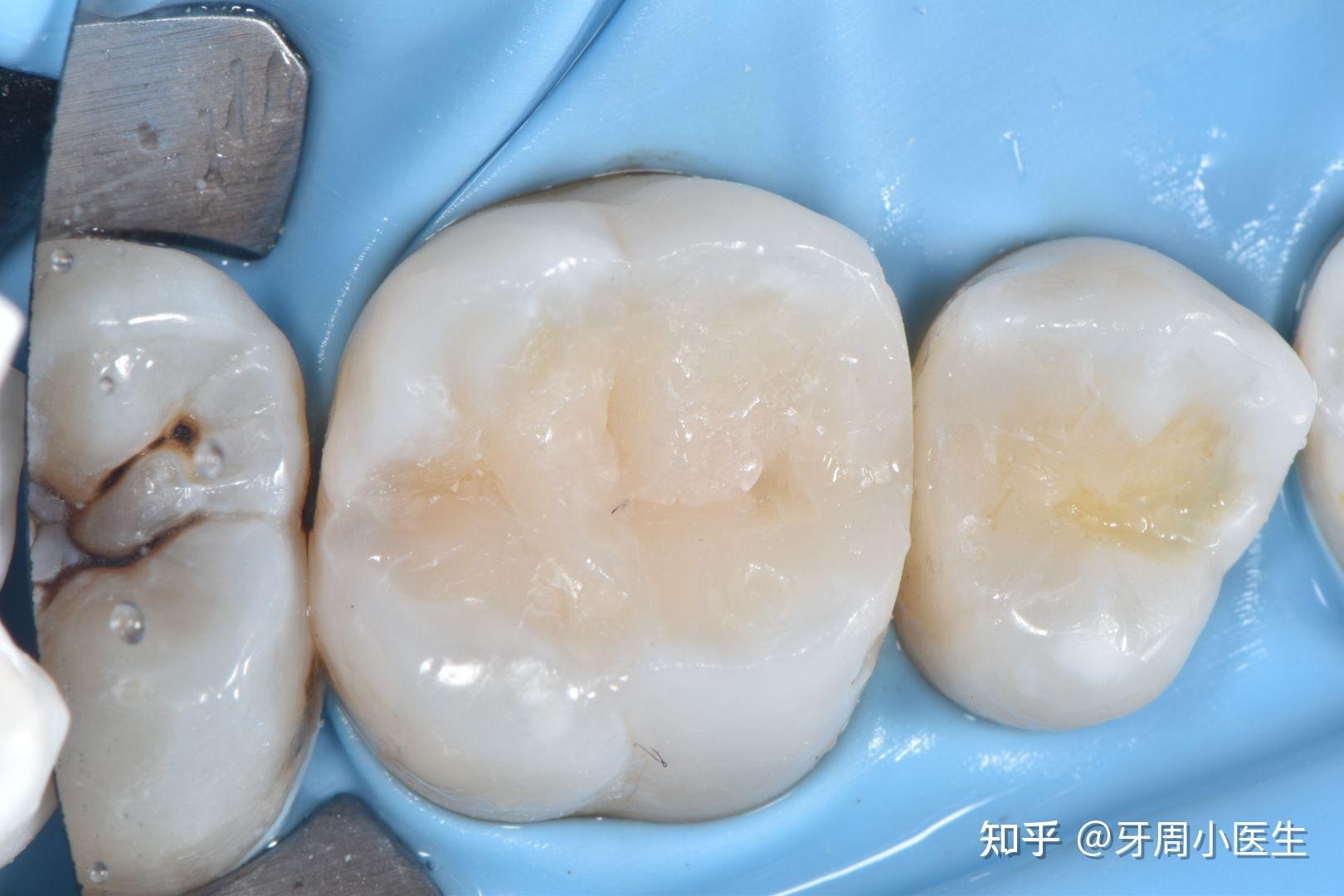 3m唯美树脂补牙一颗400正常吗