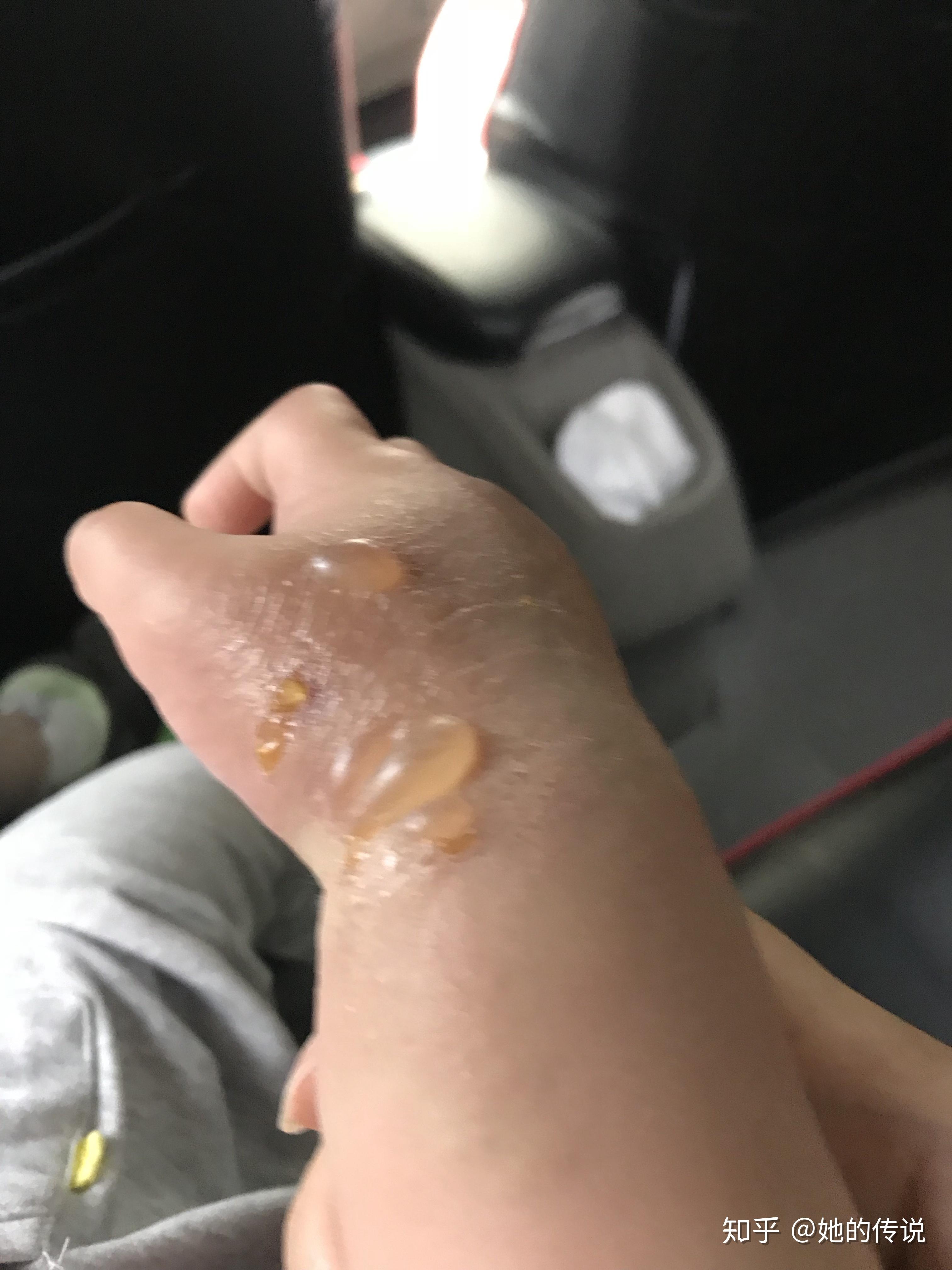 被隐翅虫咬了怎么治?让他自己好?还是要看医生? - 知乎