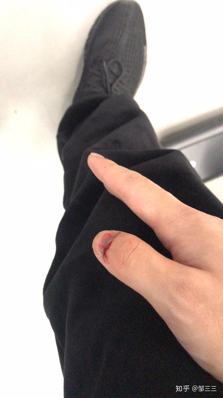 手指头被夹伤后你是什么样的感受怎么处理的