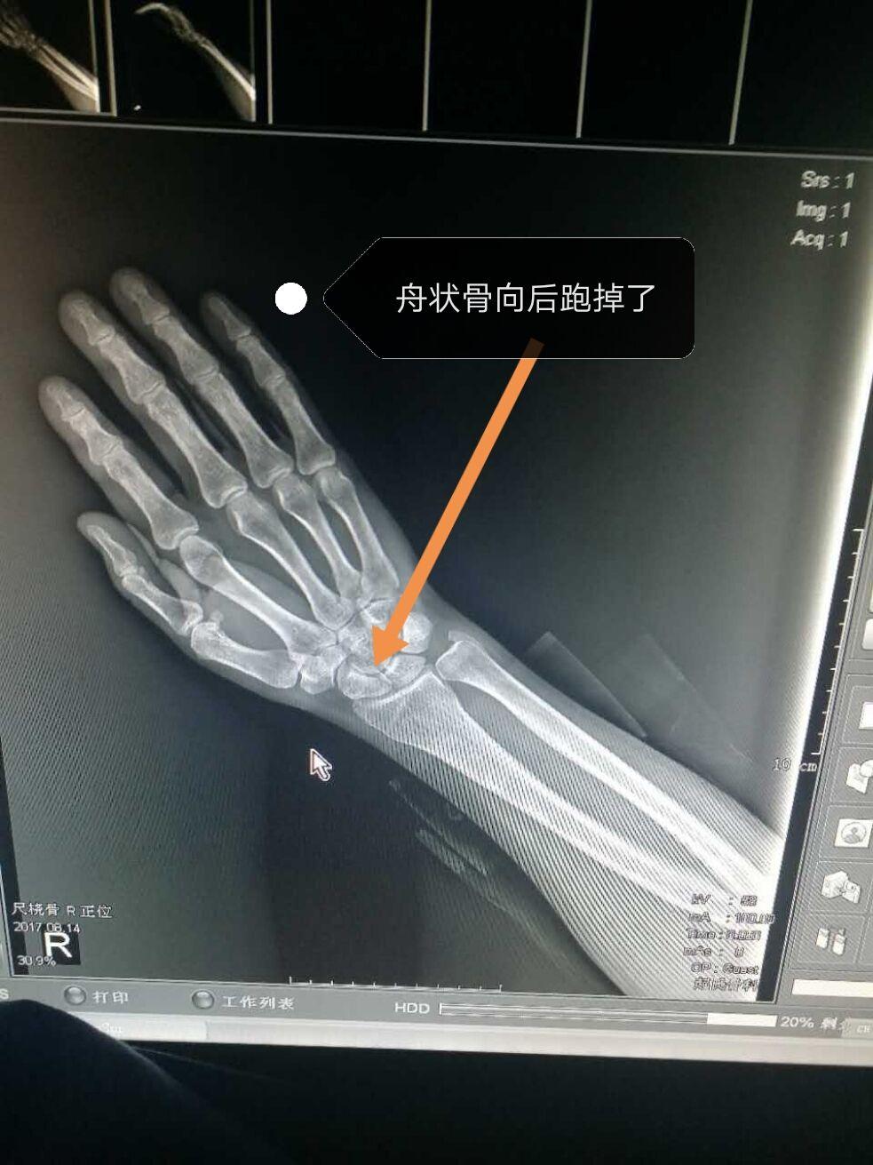 手腕弯下去,手背上骨头凸起是怎么回事? - 知乎