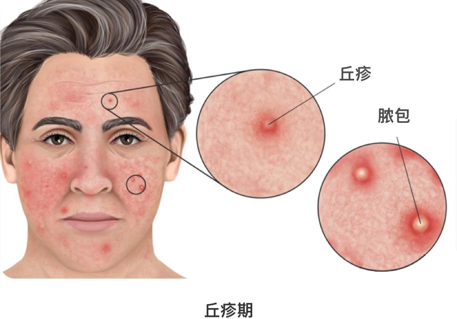 玫瑰痤疮是什么?有哪几个阶段?每个患者都会发展到最严重的阶段吗?