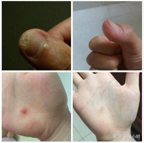 雞眼膏比手上雞眼大會腐蝕健康皮膚嗎?