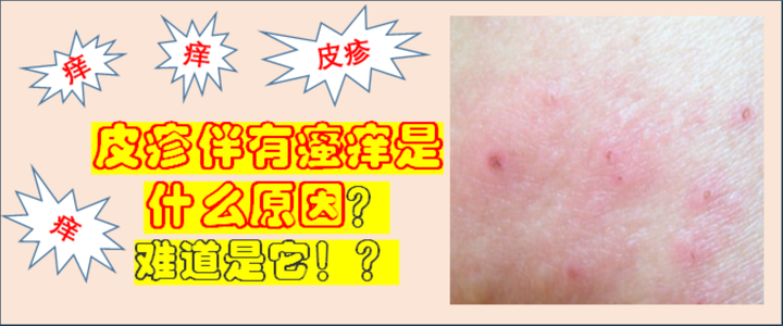 皮疹伴瘙痒是什么原因？可能是接触性皮炎，如何预防和治疗呢？ - 知乎