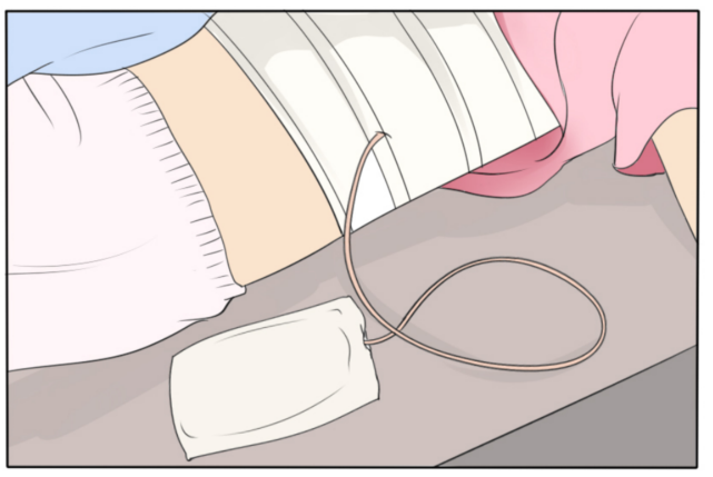 乳腺癌术后为什么要引流引流管什么时间可以拔