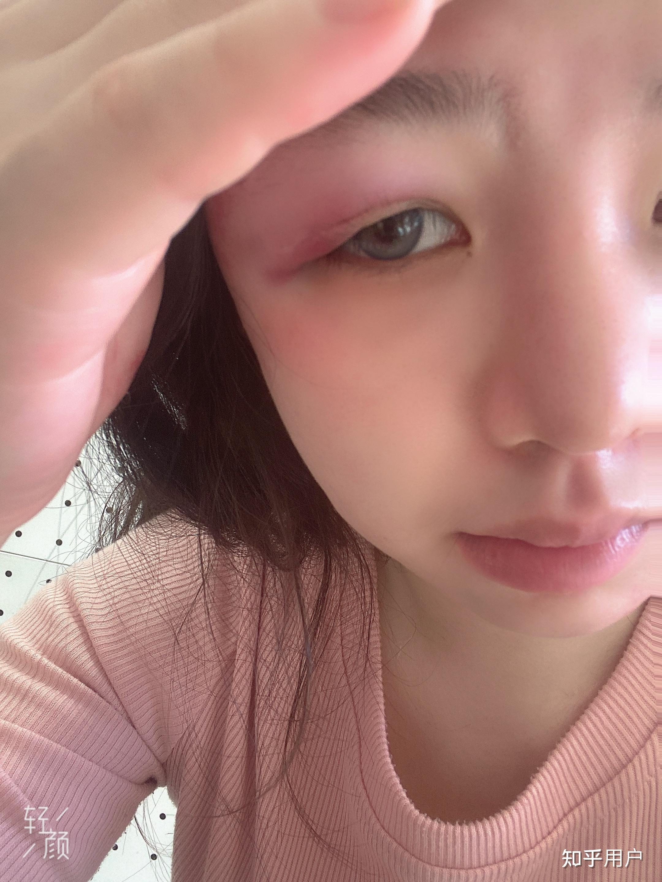 想知道眼部淤青怎么可以快速消除? - 知乎