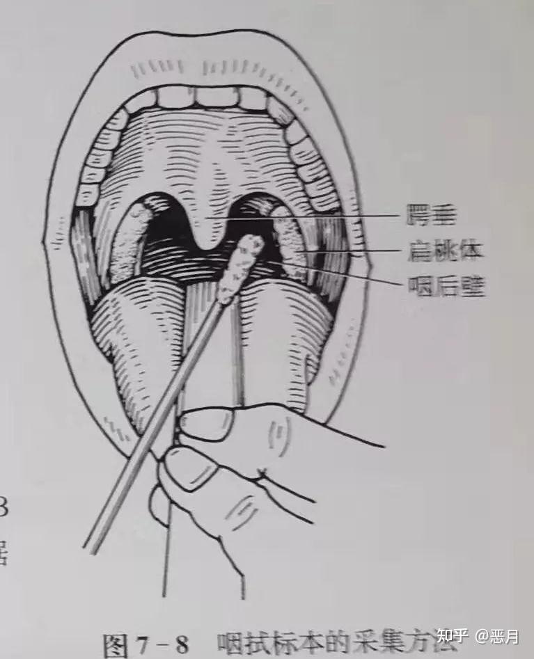 核酸檢測鼻拭子有被捅出血的可能嗎如果有可以索要賠償嗎