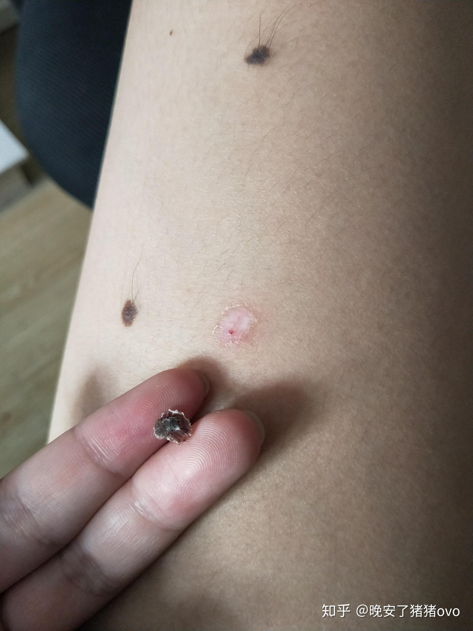 治寻常疣花掉了1000元这正常吗