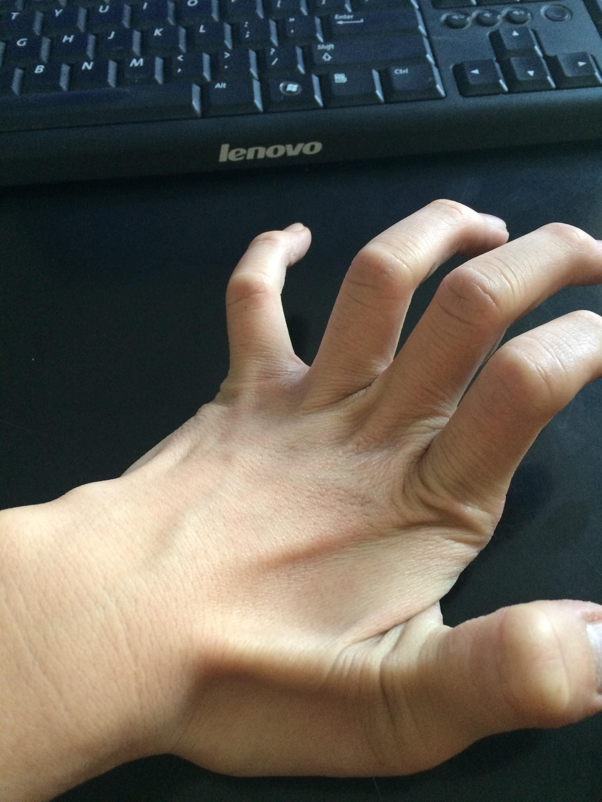 手指弯曲是什么原因造成的? - 知乎