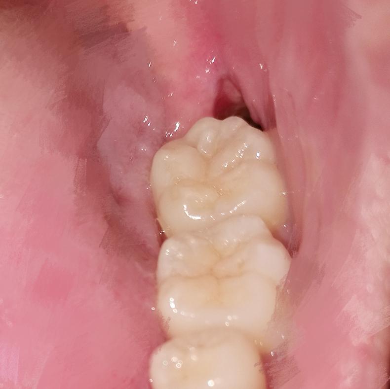 拔完牙后肉里面有大坑食物残渣容易掉进去想知道如何清洁掉