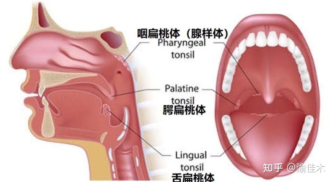 哪些是引起扁桃体炎的关键因素