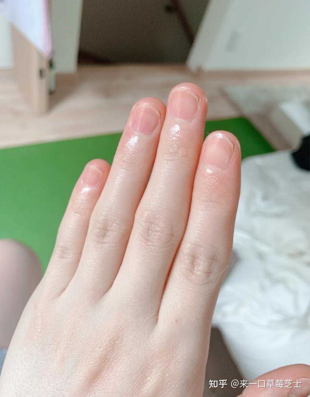 女生手指关节发黑何解决?