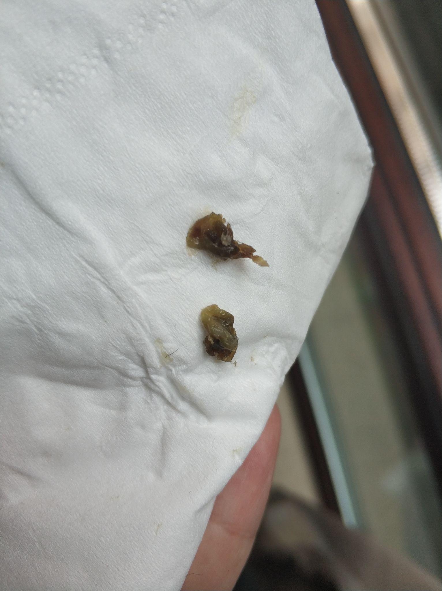 人的鼻屎能大到什么程度