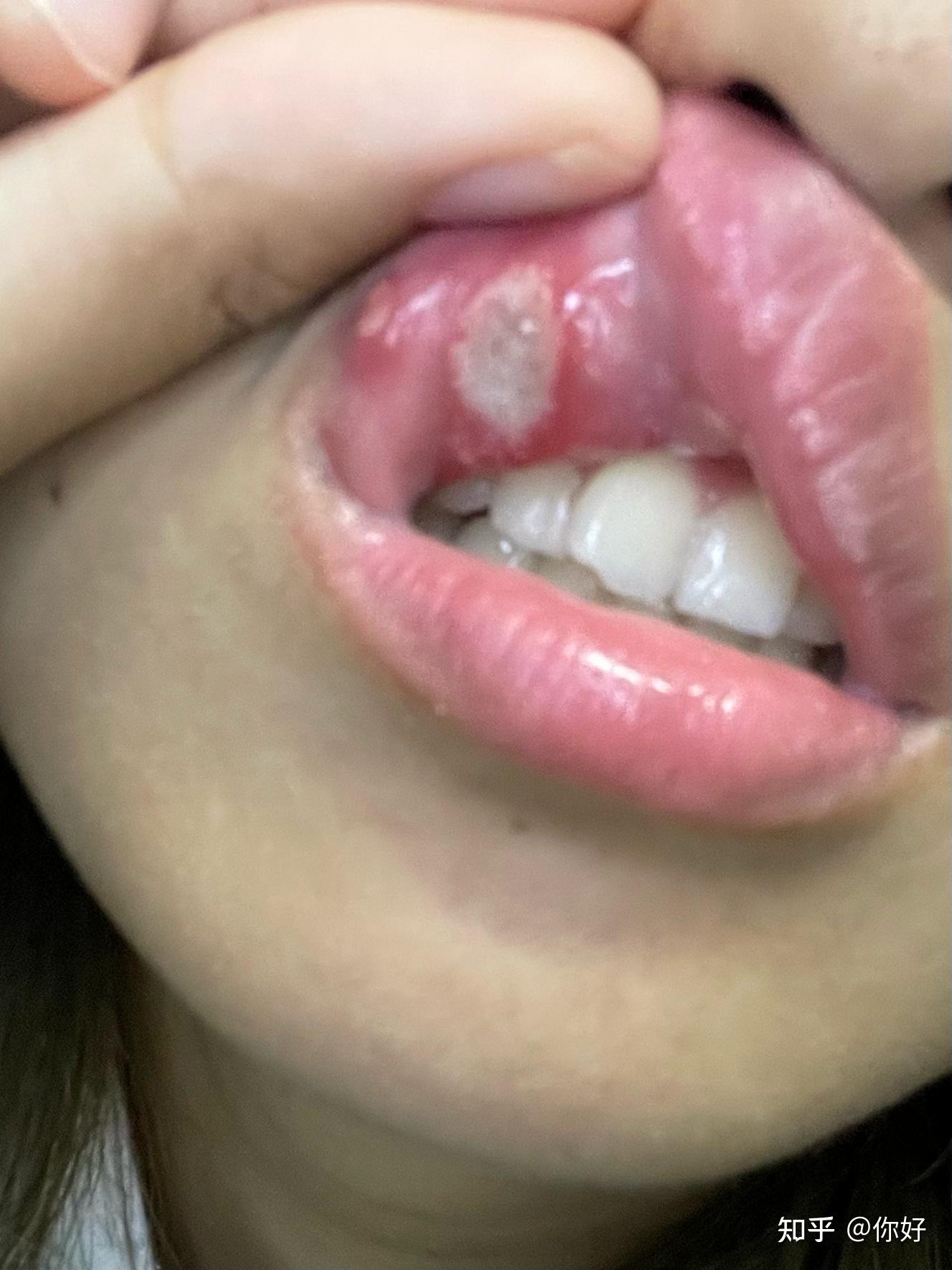 你见过最大的口腔溃疡有多大?