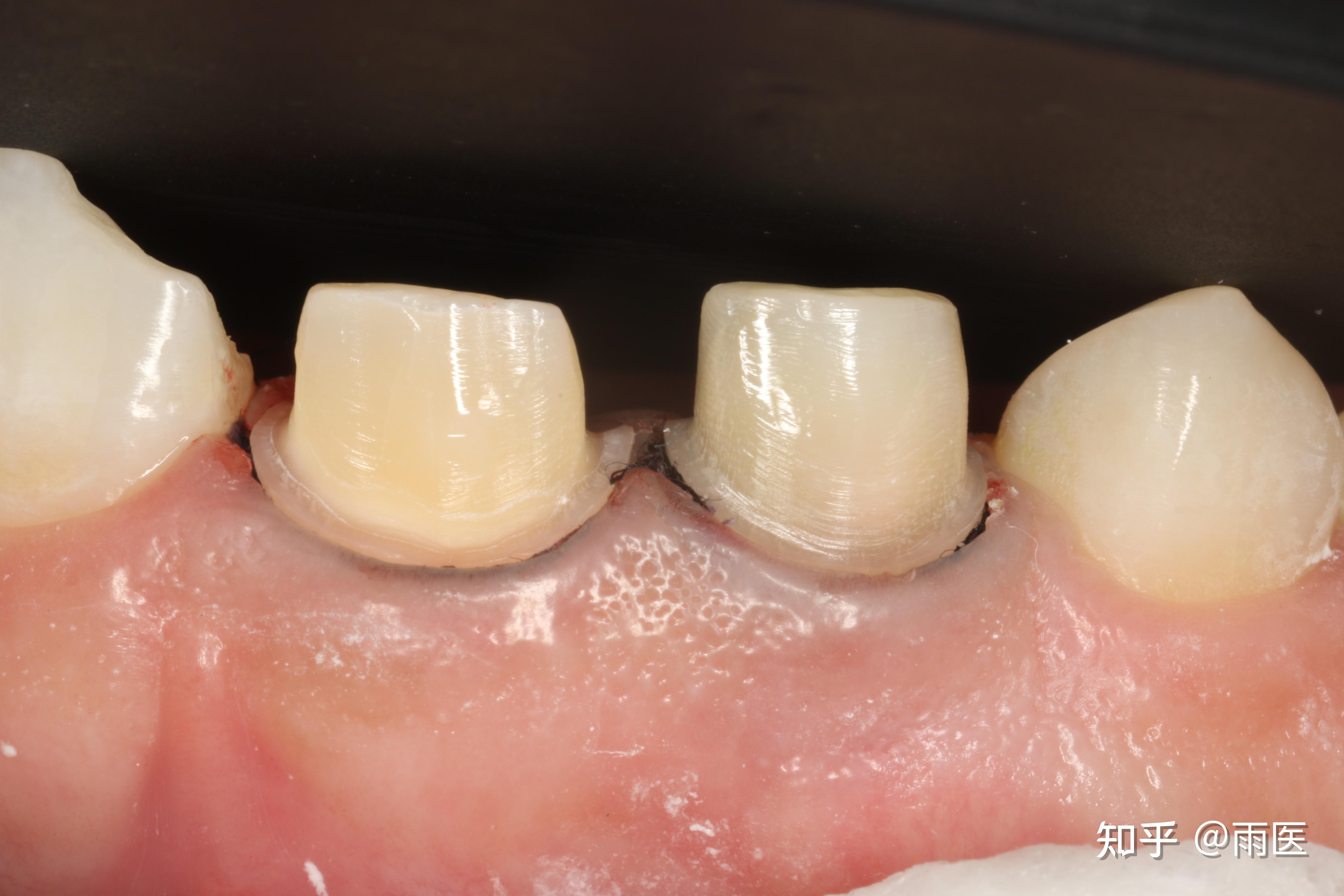 烤瓷牙里面的基牙如何防腐烂