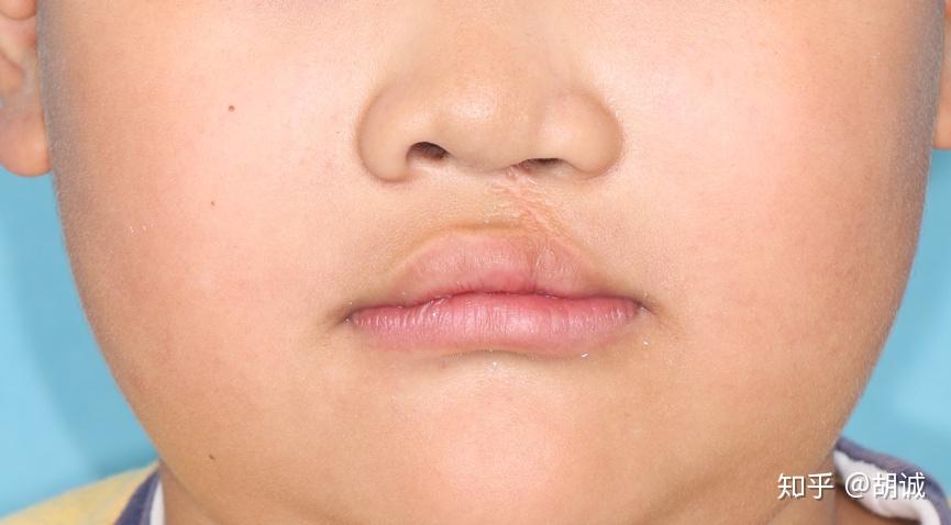 孕妈们四维要是检查出胎儿唇腭裂你们会不会要? - 知乎