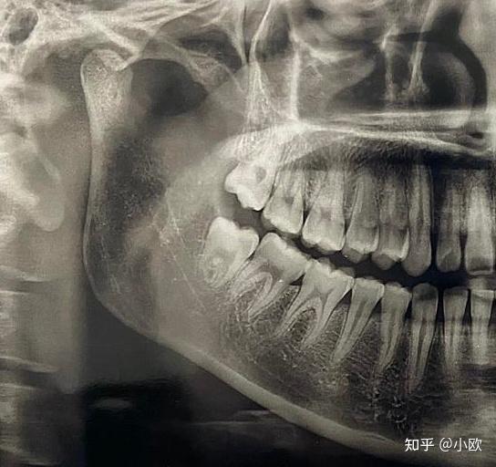 什么样的智齿不用拔