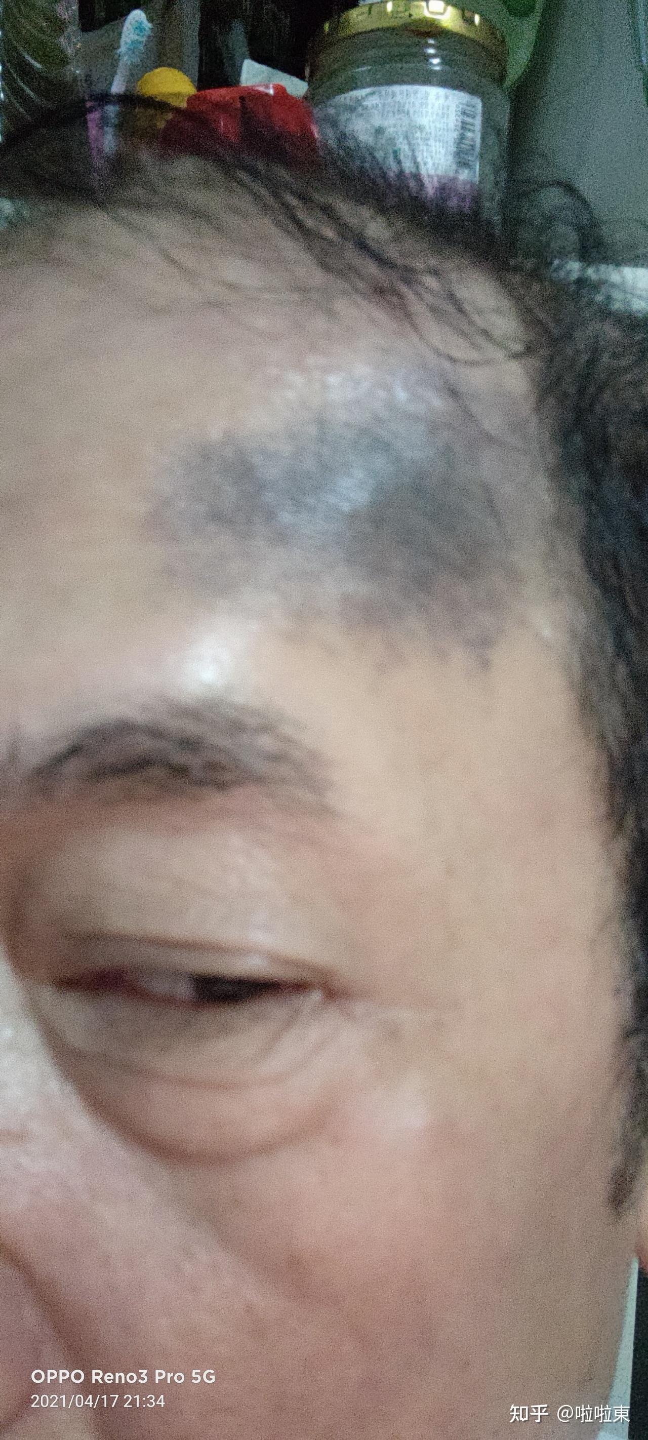 额头两侧发黑是怎么回事?