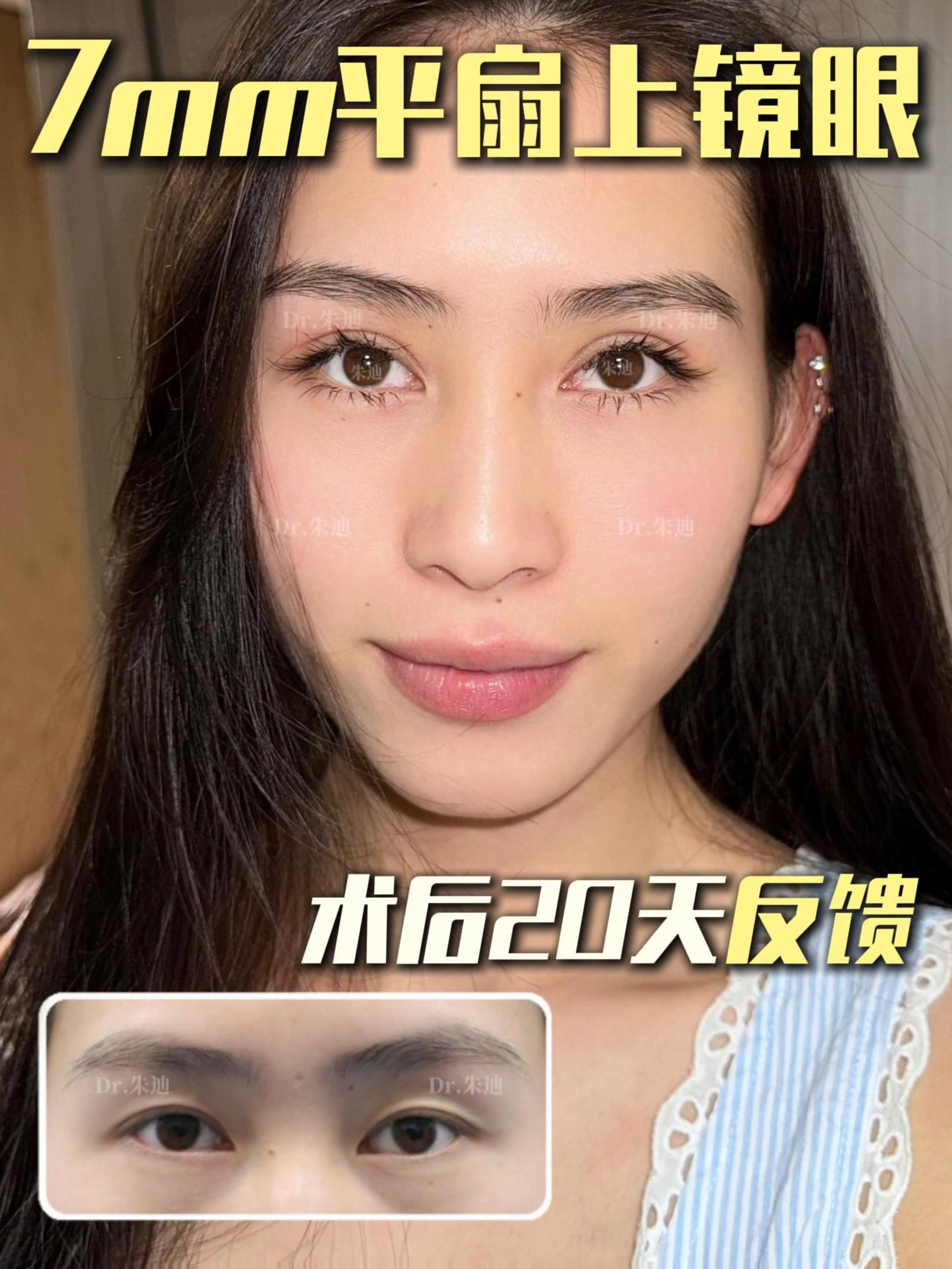 7mm平扇上镜眼20天反馈小姐姐说朋友圈被夸爆了后悔没有早点做