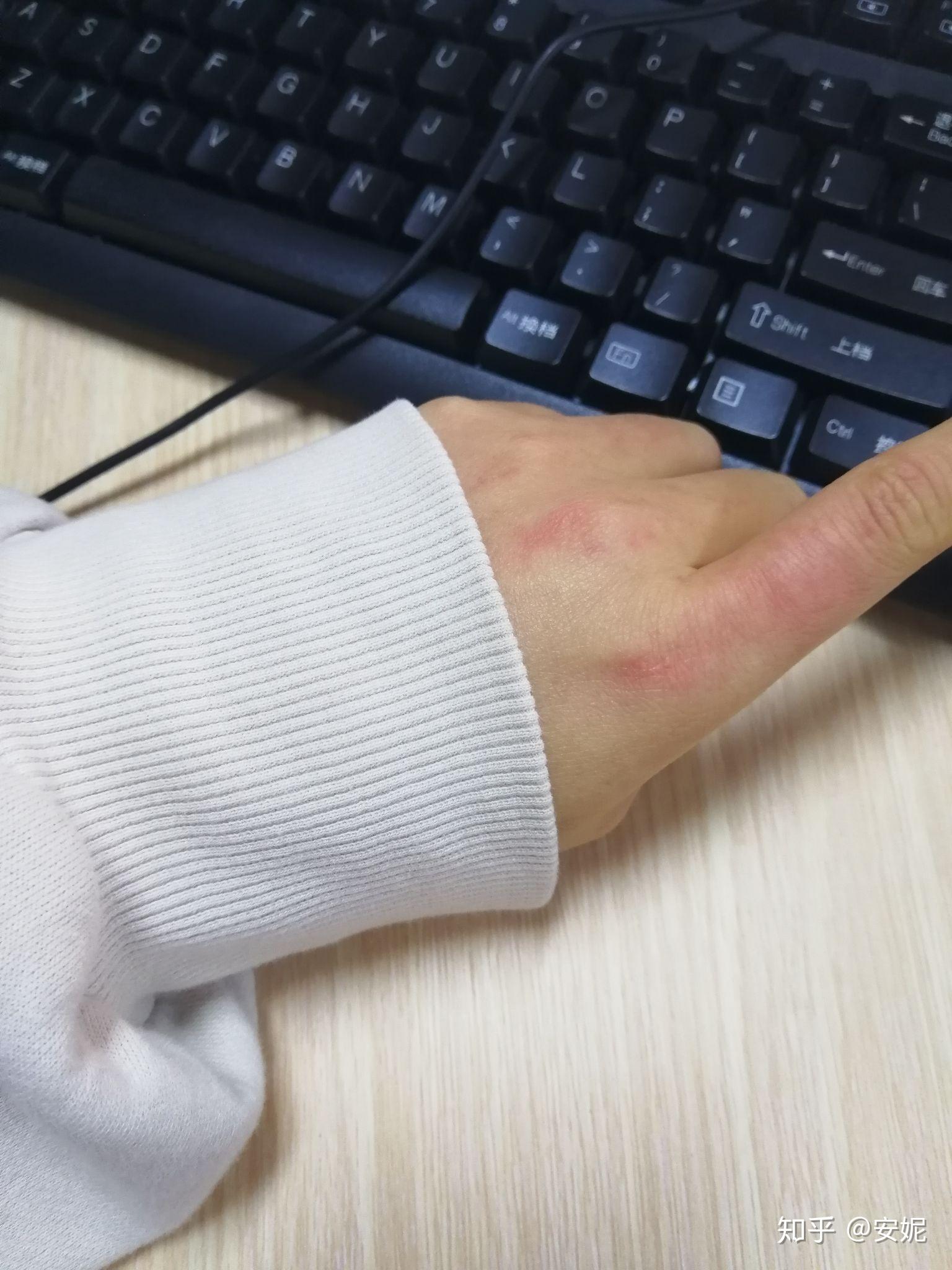 皮肤一冷就发紫浑身都是这样温度越高越白皙宝宝略痘印冻紫我的天恁们