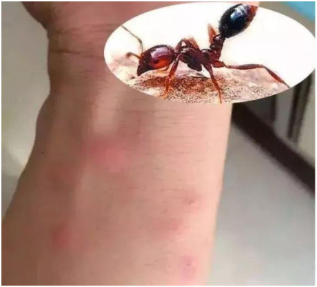 飞蚂蚁咬人后症状图片图片