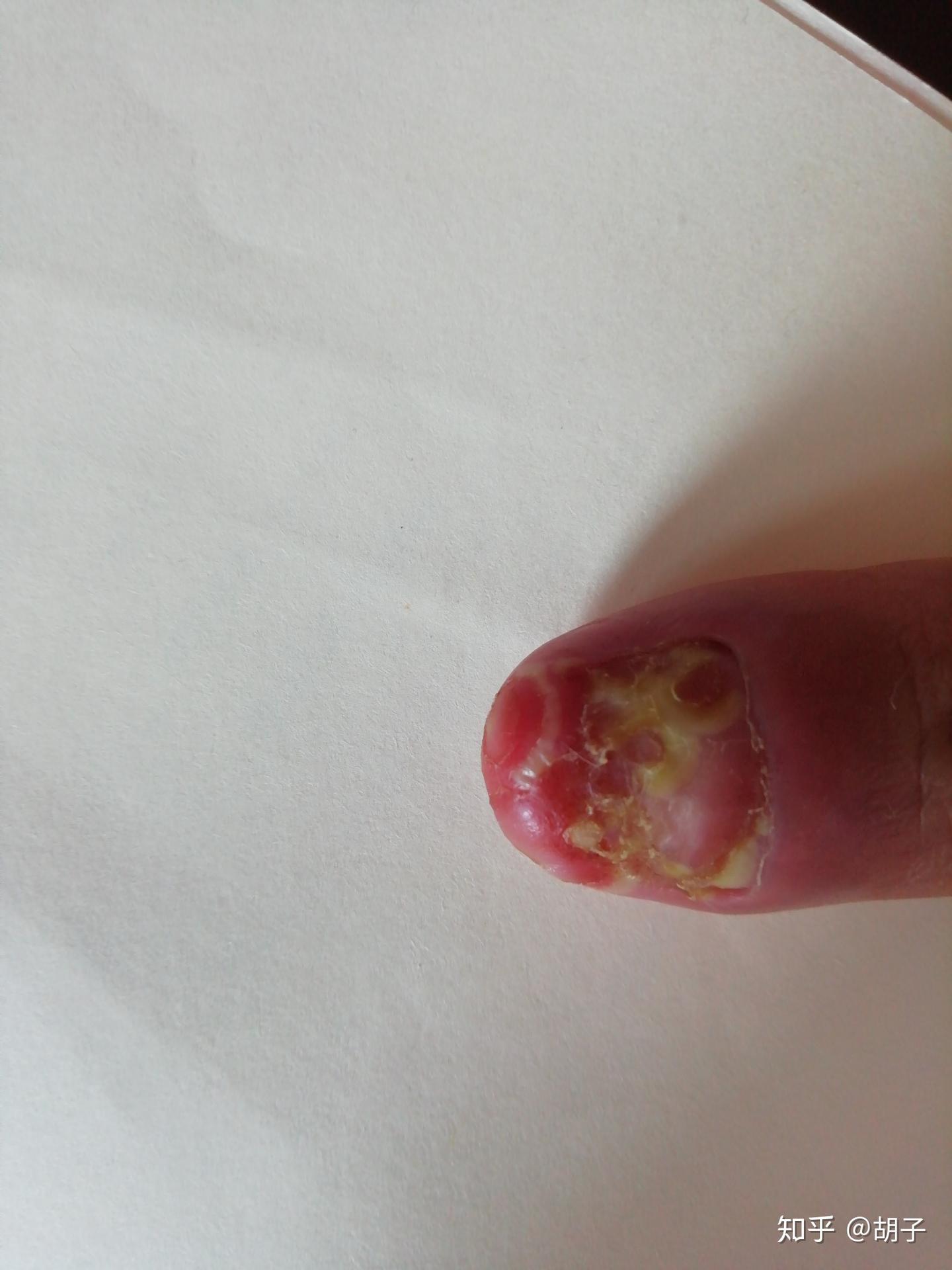 连续性肢端皮炎的诊断及治疗现状- 知乎