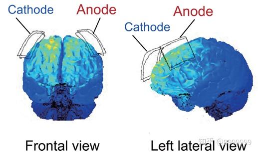 经颅直流电刺激 (transcranial direct current stimulation / tdcs)