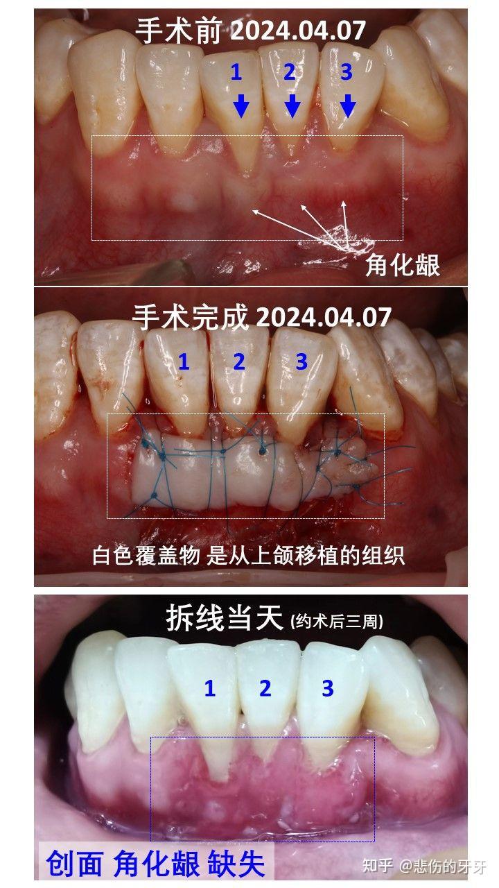 膜龈手术 失败案例