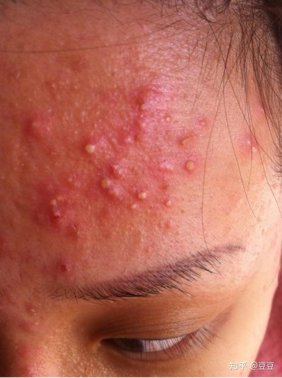 以前脸干净的要命突然在额头上长闭口很多很多怎么办