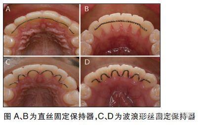 牙齿矫正结束后的保持器需要“终身佩戴”吗? - 知乎