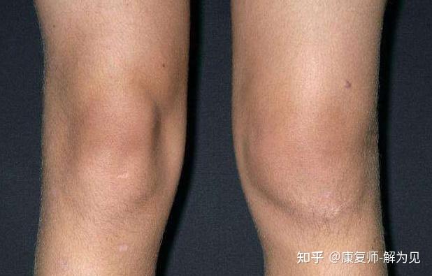 膝关节有积液可以跑步么? - 知乎