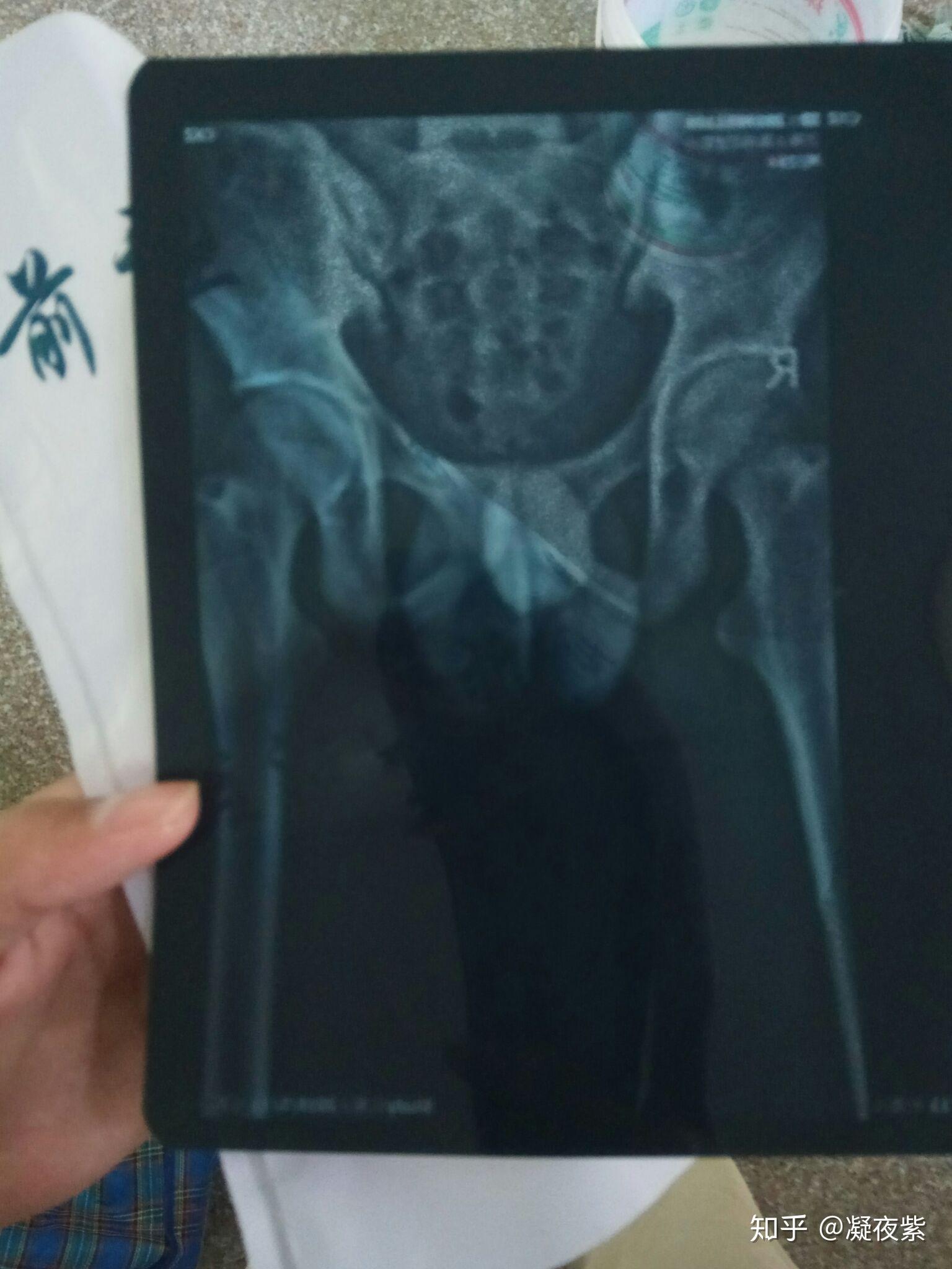 尾椎骨疼痛怎么办