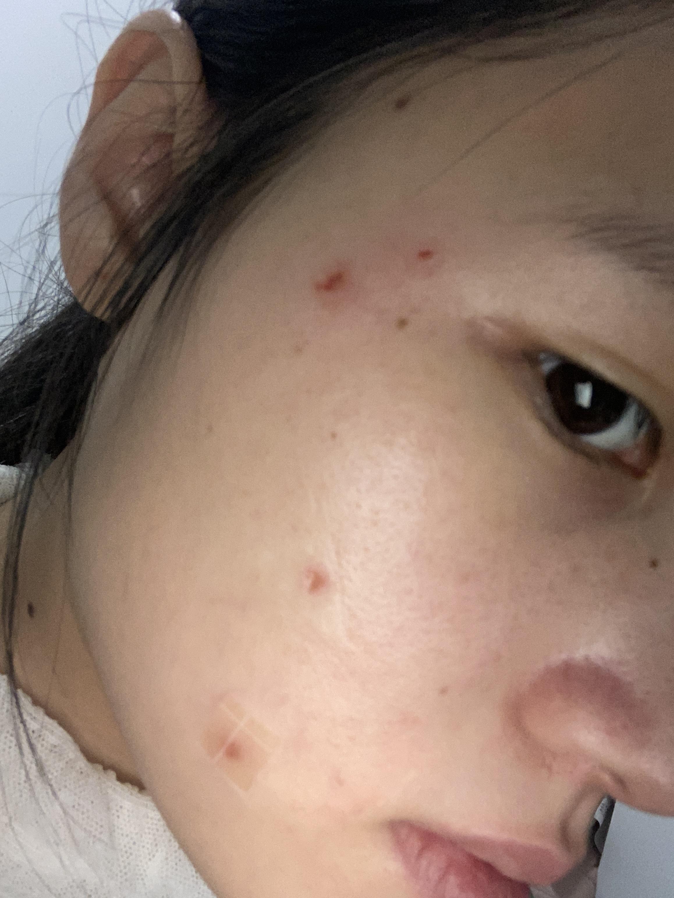 激光点痣第6天这样正常吗