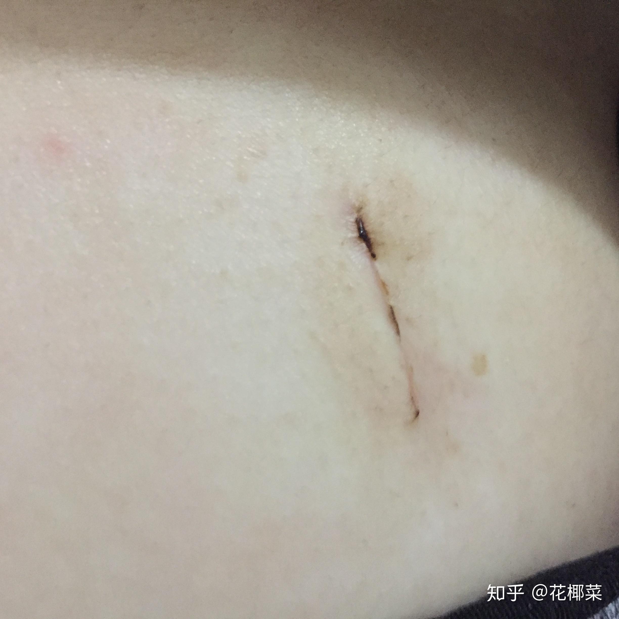 乳腺纤维瘤疤痕图片