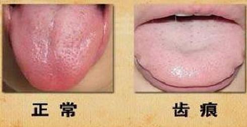 舌头上出现了齿痕，这是怎么回事？ - 知乎