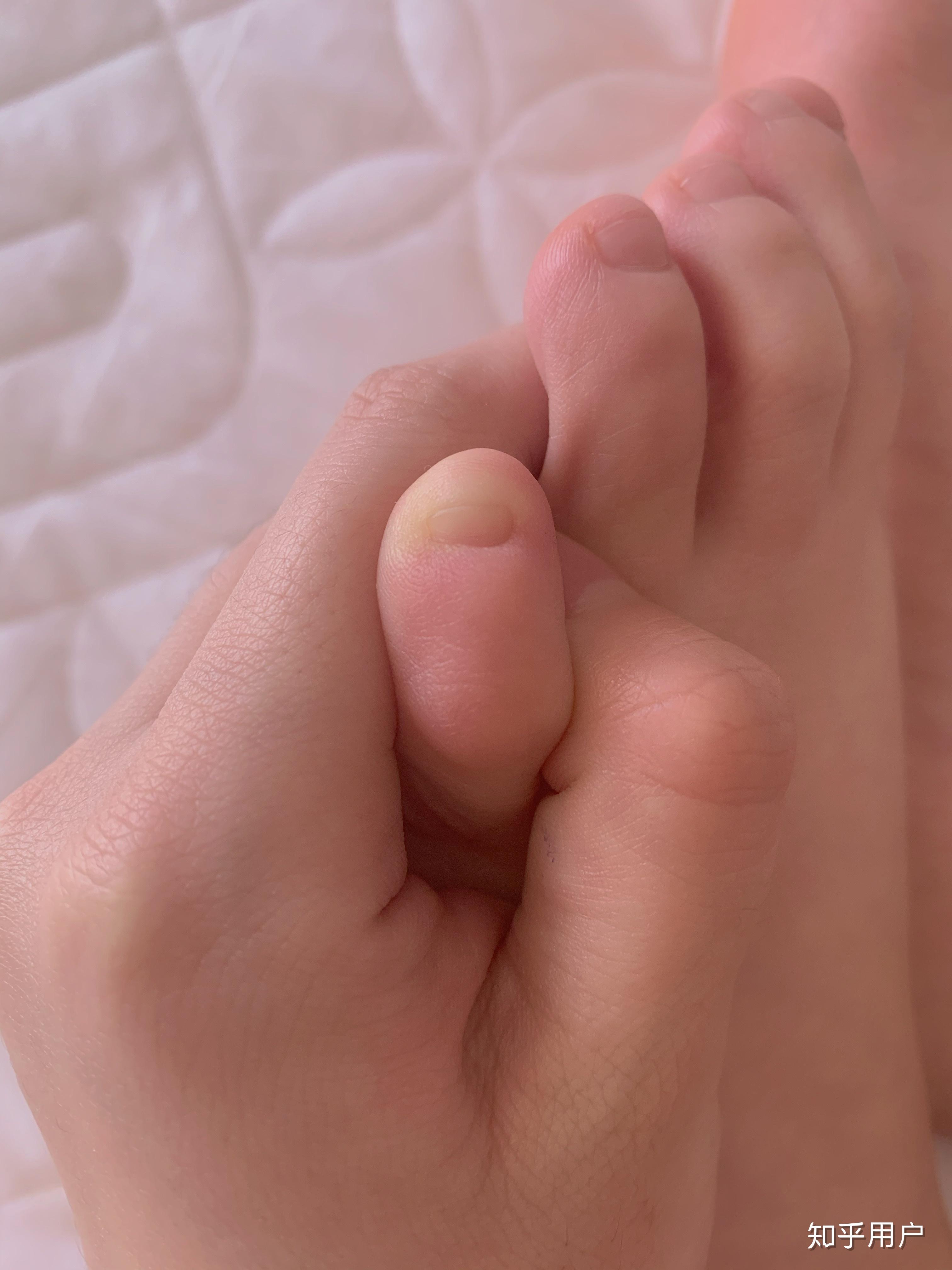 小拇脚指指甲两瓣是怎么回事?