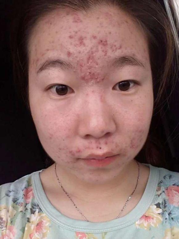 额头上好多小粉刺脸上痘痘怎么办