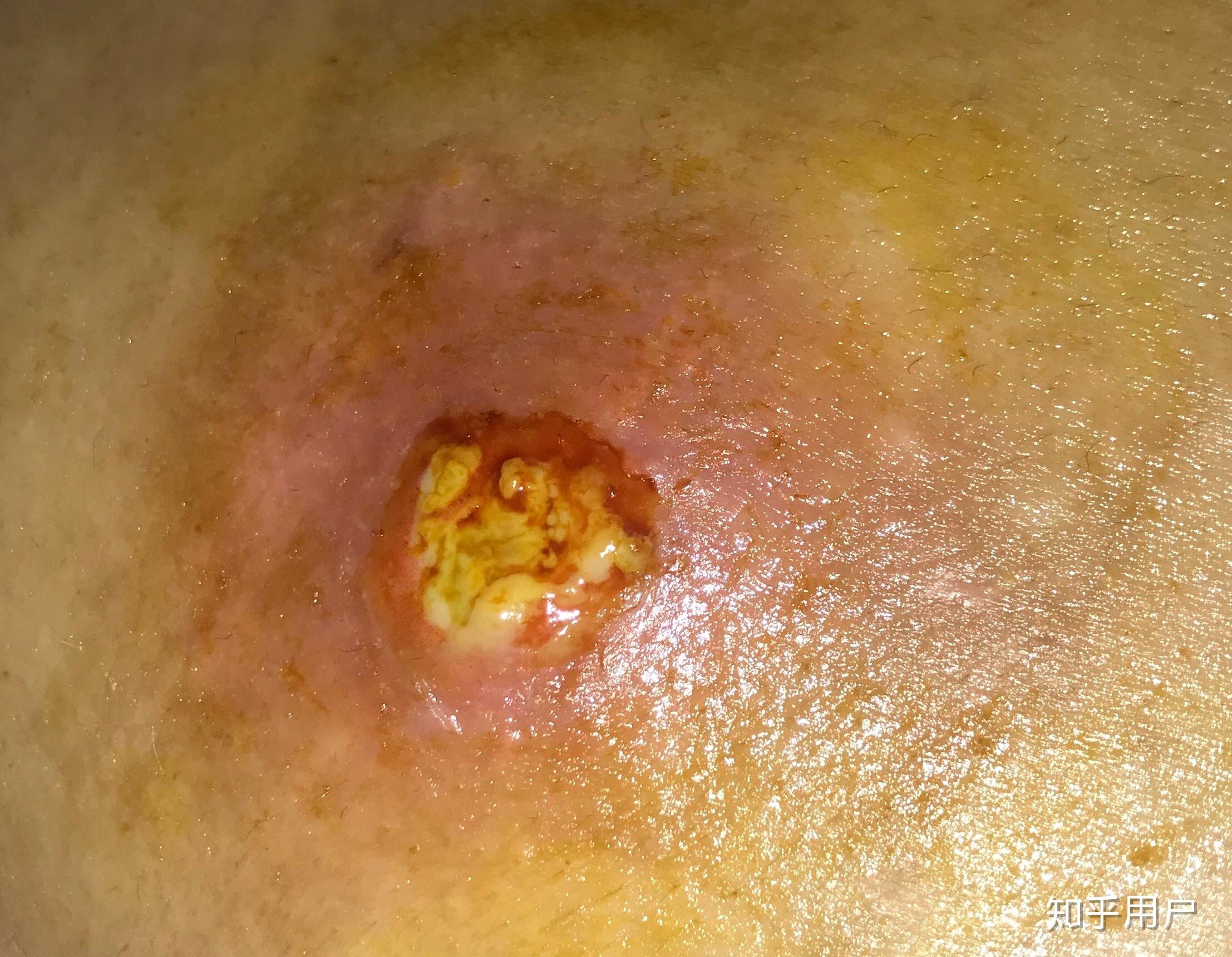 频繁长疖肿怎么办