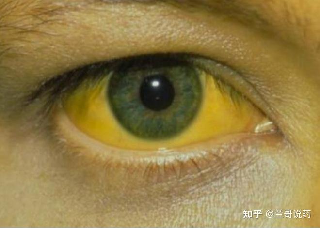 肝病患者为什么会出现黄疸? - 知乎