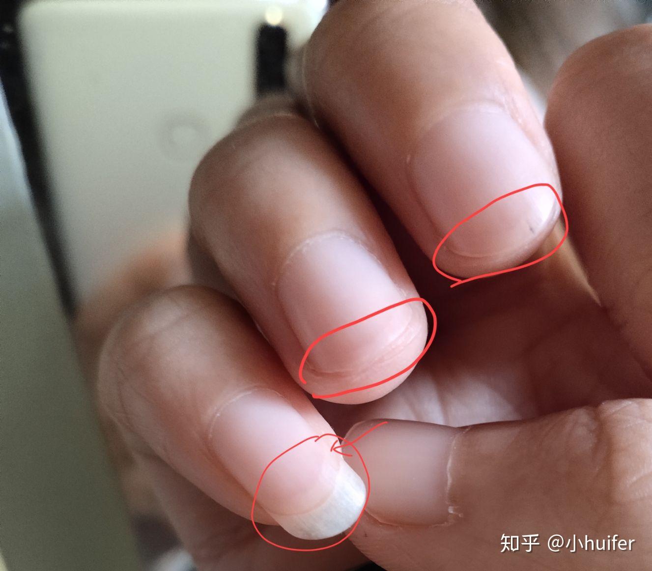 手指甲的肉线往下移是为什么啊