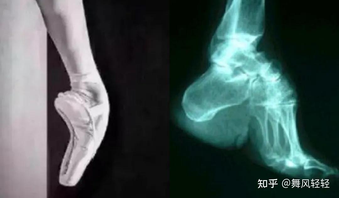 练芭蕾堪比缠足？高脚背真的是一种病态审美吗？ - 知乎