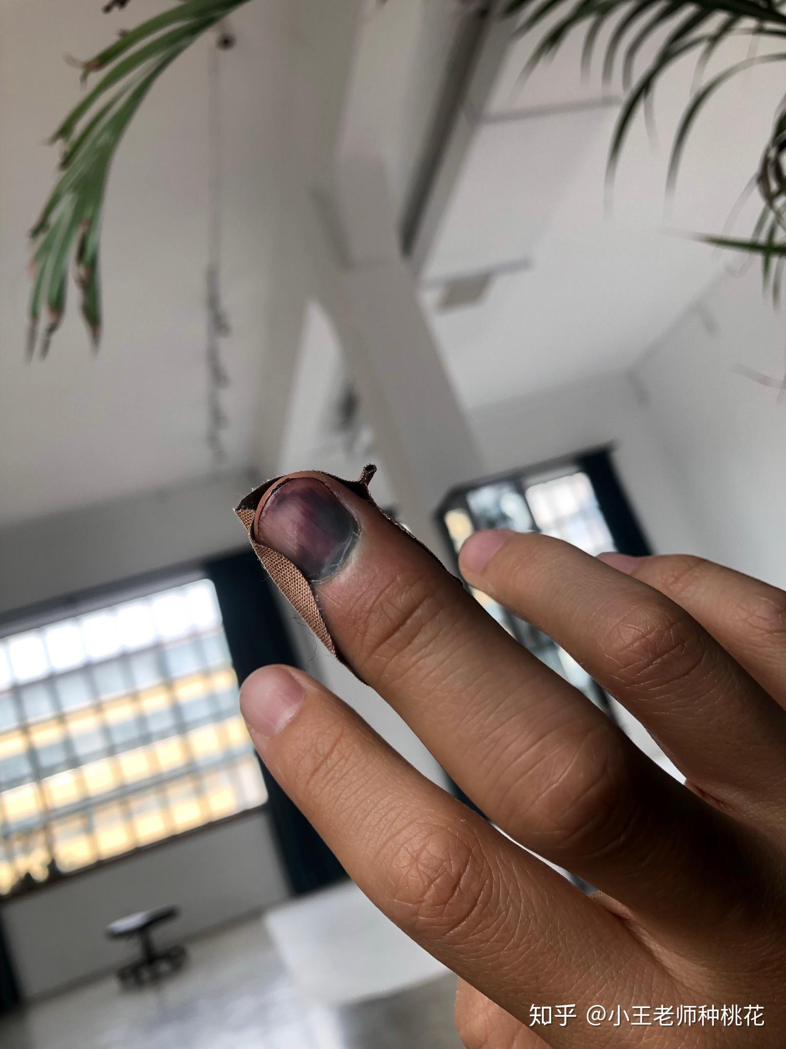 手被车门夹了怎么办