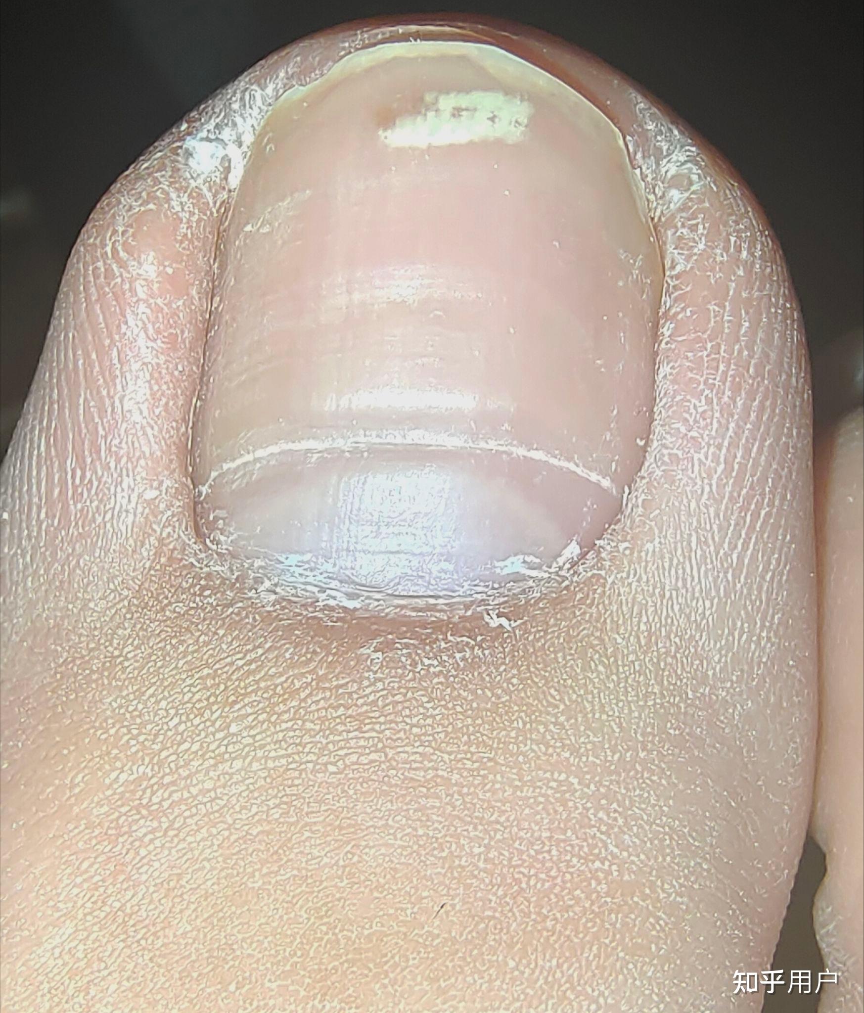 大脚趾甲有一条特别深的横纹,看起来跟裂开了一样