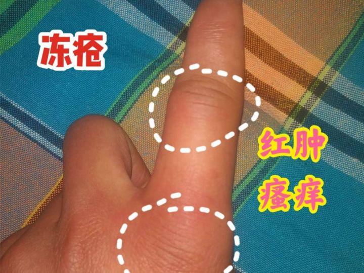 如何预防年年的冻手？ - 知乎