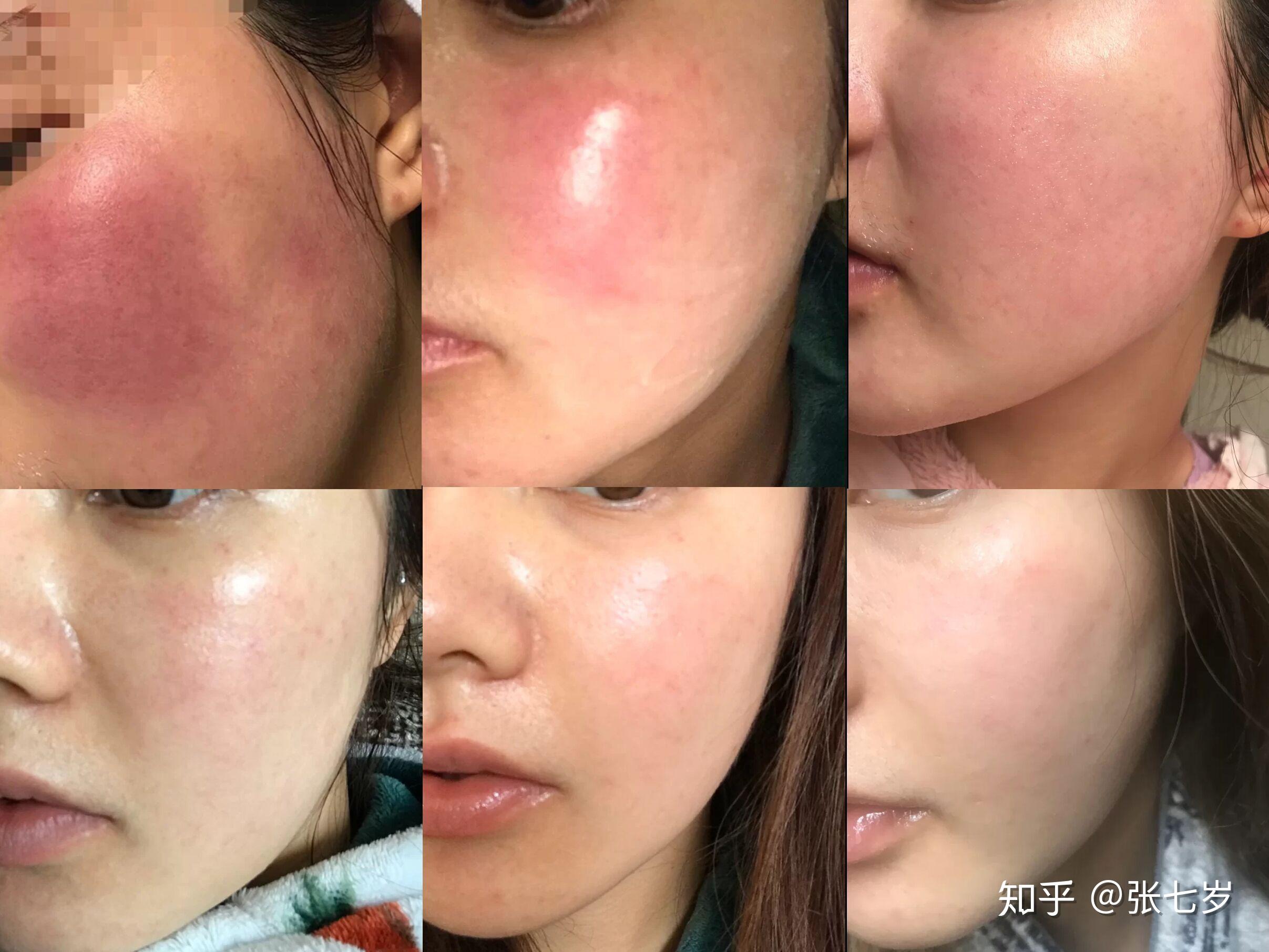 角质层薄如何修复? - 知乎