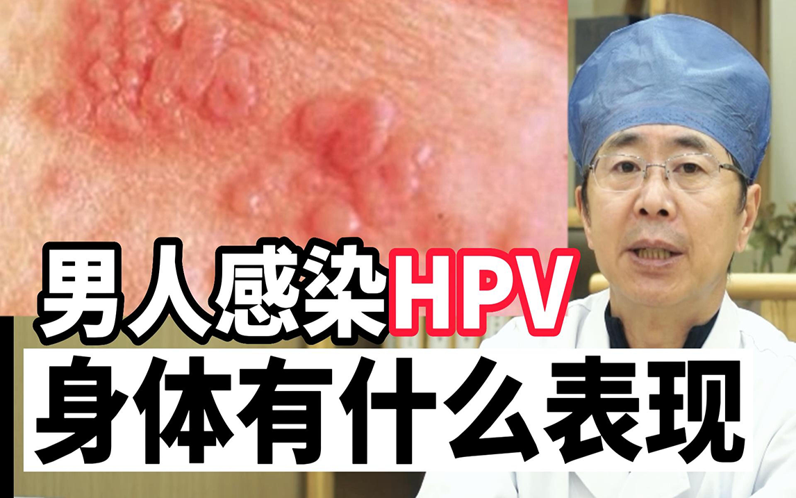 男性究竟会不会感染hpv52?有什么症状? - 知乎