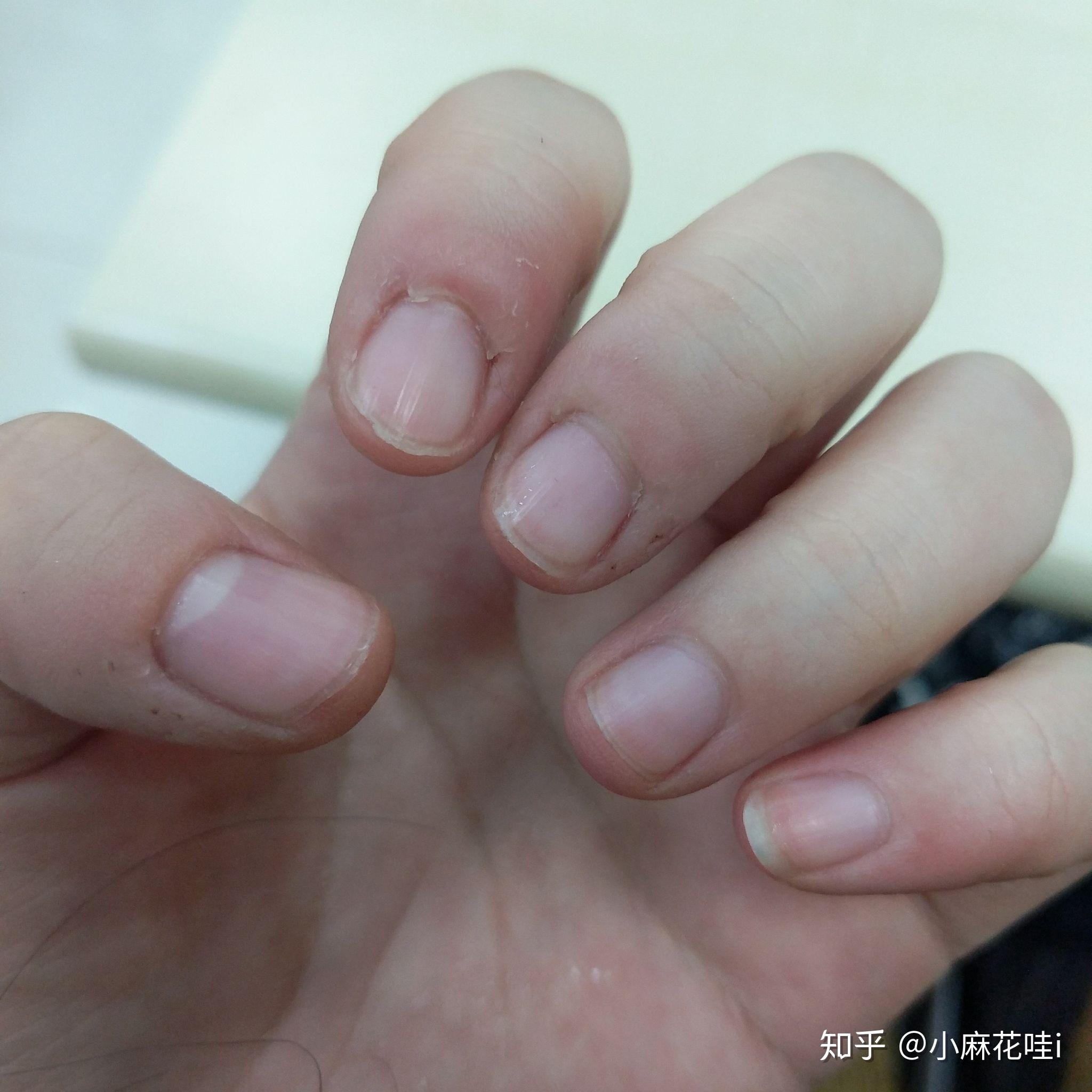 成年人如何改掉抠手的习惯?有什么心理学道理? - 知乎