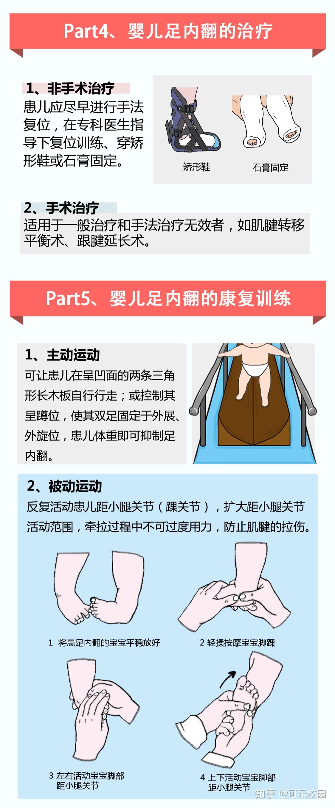 「内翻足」是怎么回事?有什么症状?如何治疗? - 知乎