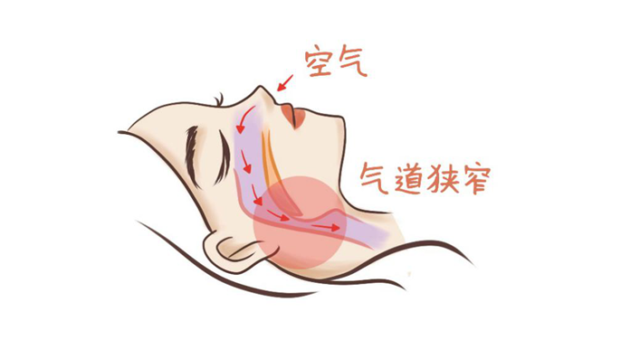 气道狭窄