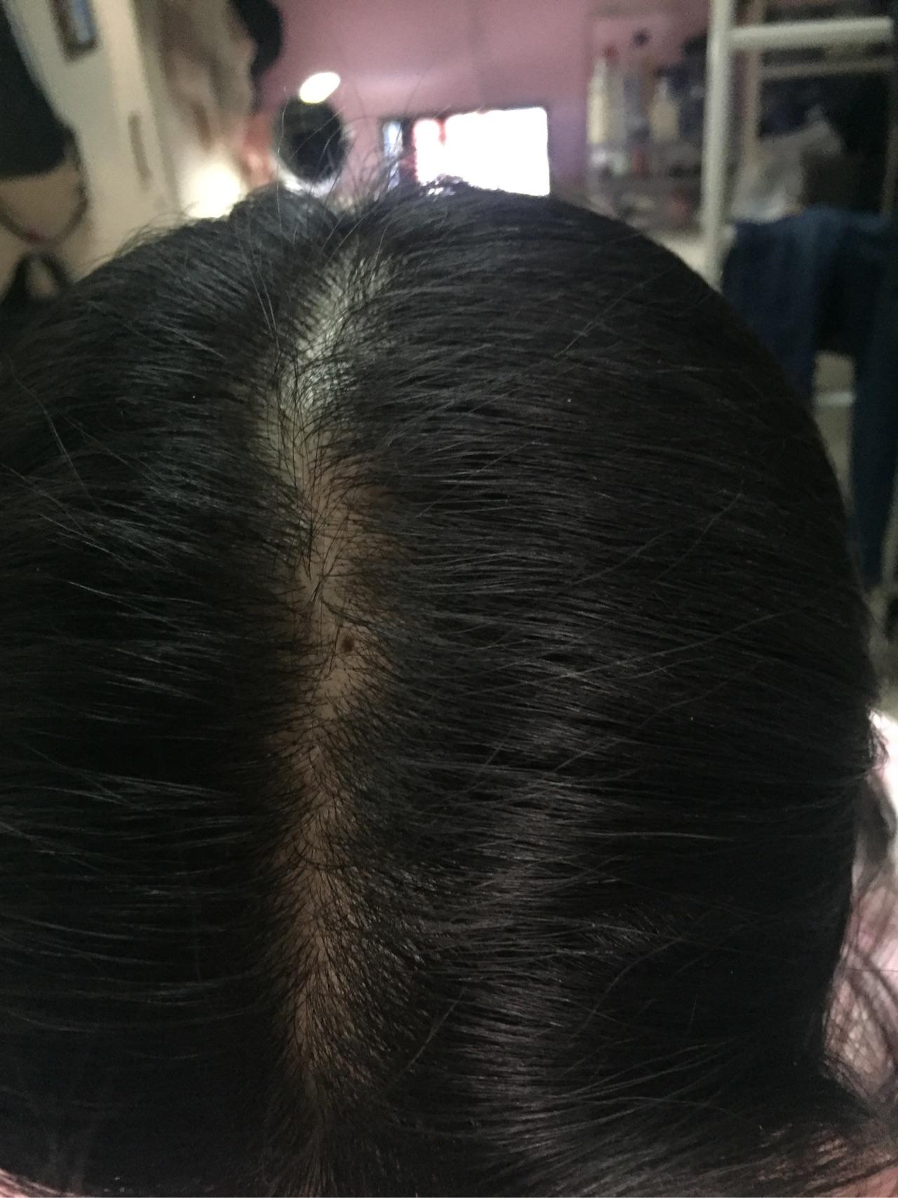 女生发量少头顶快秃了有没有什么好的生发方法跪求