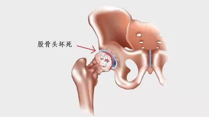 早期股骨头坏死的饮食注意